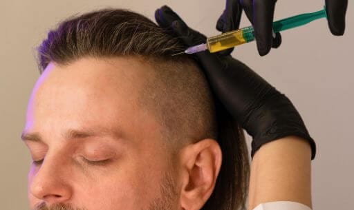 GFC injection into the scalp