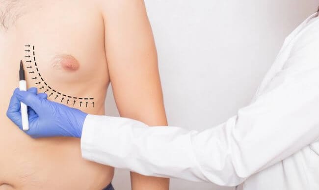 Chest marked before gynecomastia surgery