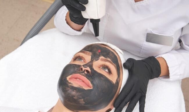 Carbon laser peel with a carbon mask on the face