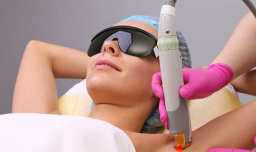 Laser hair removal on the underarm