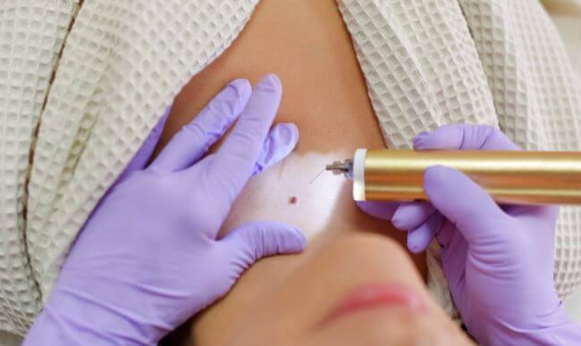 Doctor removing a mole