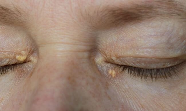 Xanthelasma deposits on the eyelids
