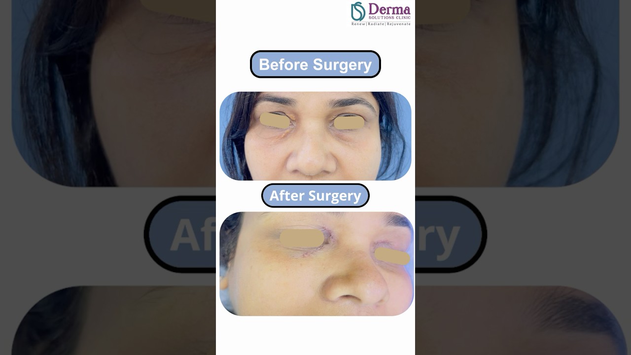 Xanthelasma Removal by Surgical Excision | Derma Solutions Skin Clinic Bangalore.