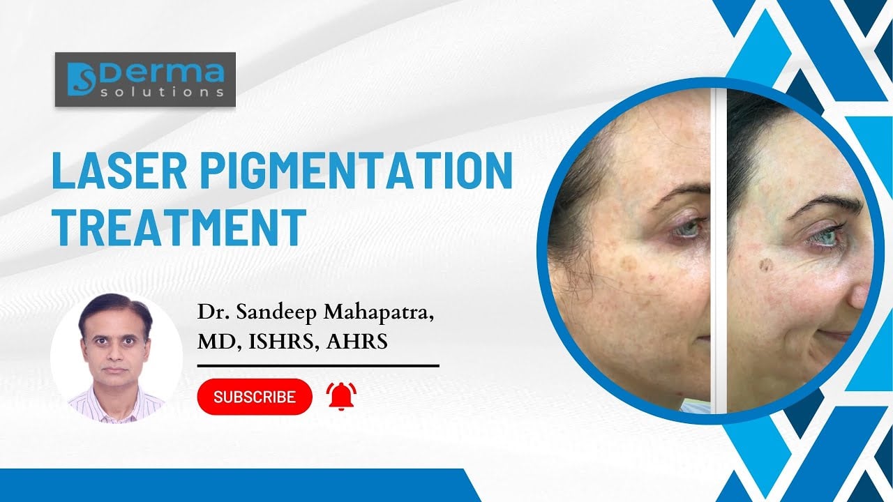 Laser Pigmentation treatment Bangalore | laser treatment for dark spots | laser dark spot removal