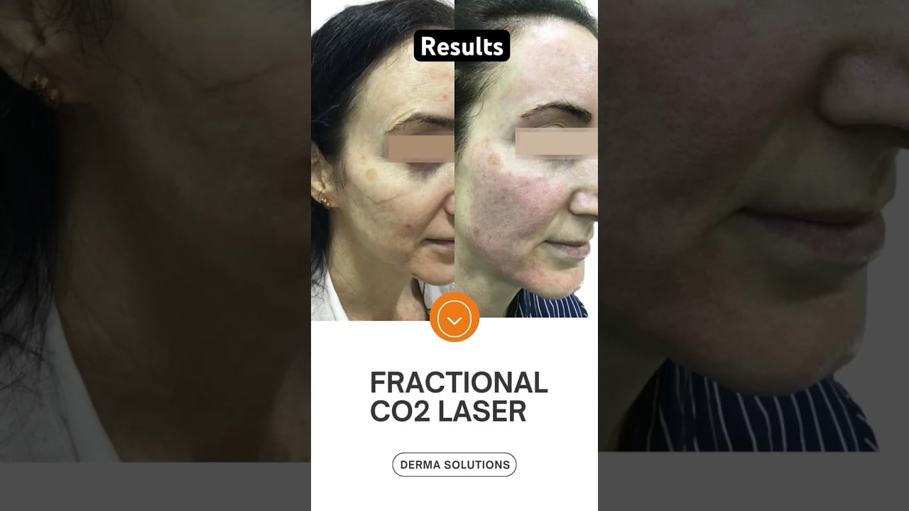 CO2 Fractional Laser Before & After Results | Best skin clinic in Marathahalli, Bangalore.