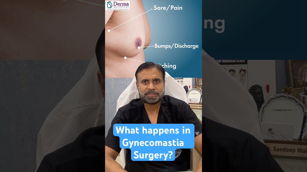 Gynecomastia Surgery Walkthrough – Procedure, Recovery & Results | Derma Solutions Bangalore