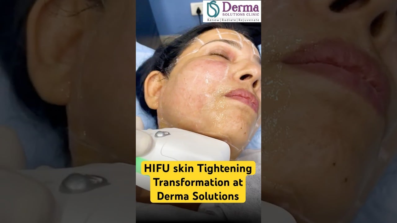 HIFU Skin Tightening Transformation | Best skin clinic in Bangalore.