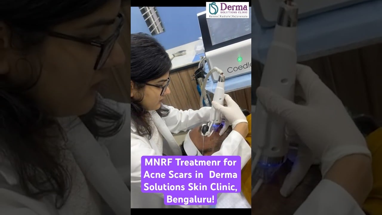 Microneedling Radiofrequency Treatment for Acne Scars in Bangalore | Derma Solutions Skin Clinic.