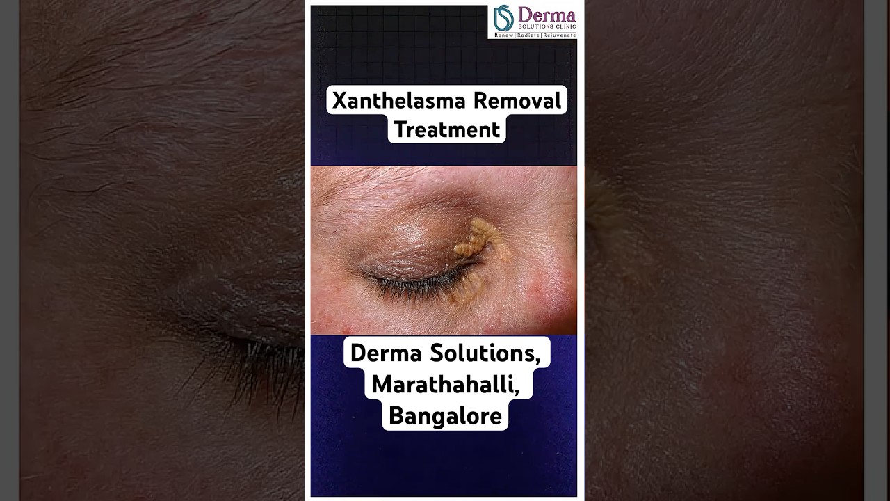 Xanthelasma Removal Treatment | Cholesterol Deposits Around Eyes | Derma Solutions Bangalore
