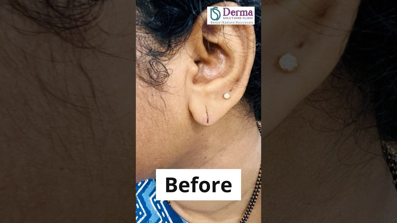 Ear Lobe Repair Surgery at Derma Solutions Clinic Bangalore | Expert Lobuloplasty by Dr. Sandeep