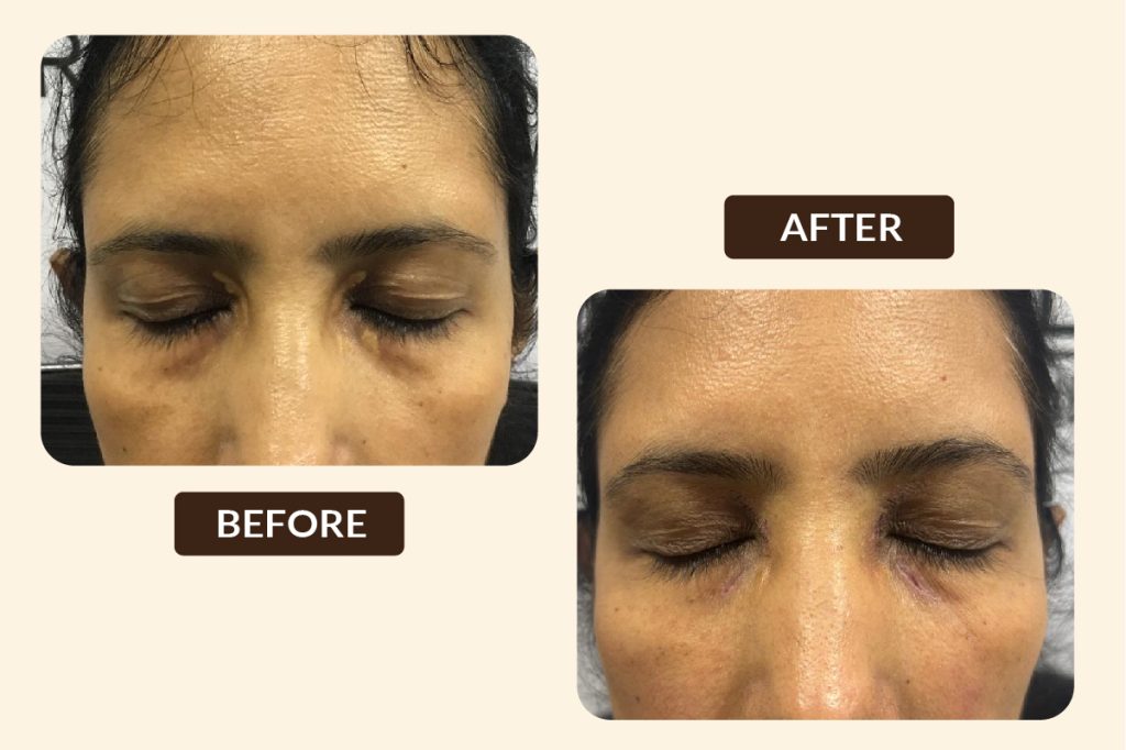 BEFORE AFTER PHOTOS